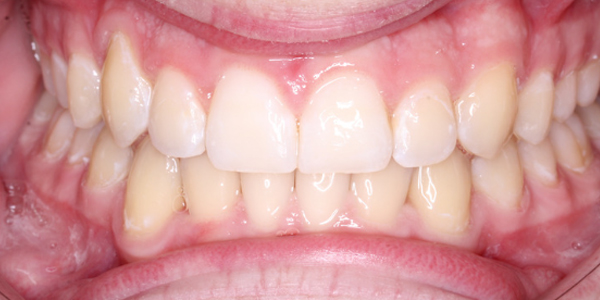 After Invisalign Treatment