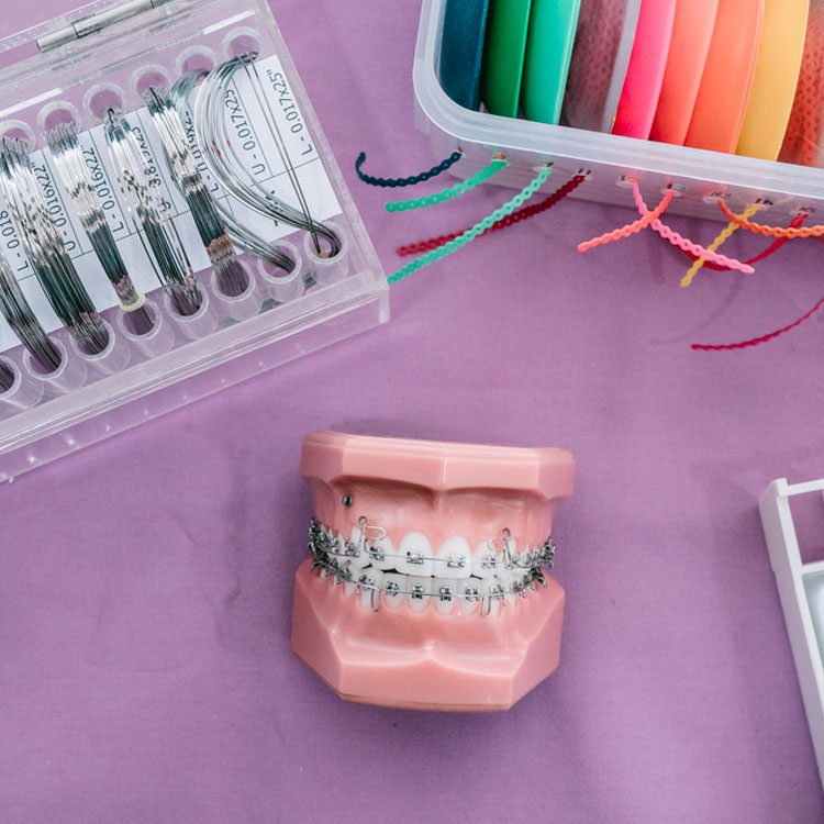 What are Braces?