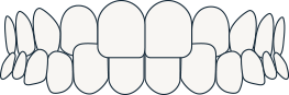 Crossbite