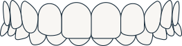 Overbite