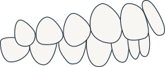 Overjet