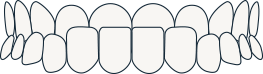 Underbite