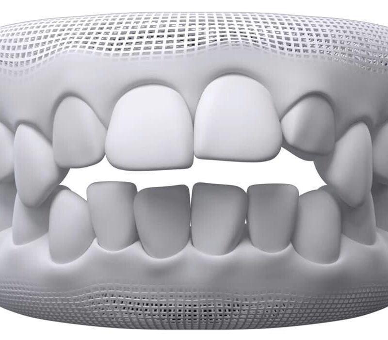 Understanding Open Bite and Its Impact