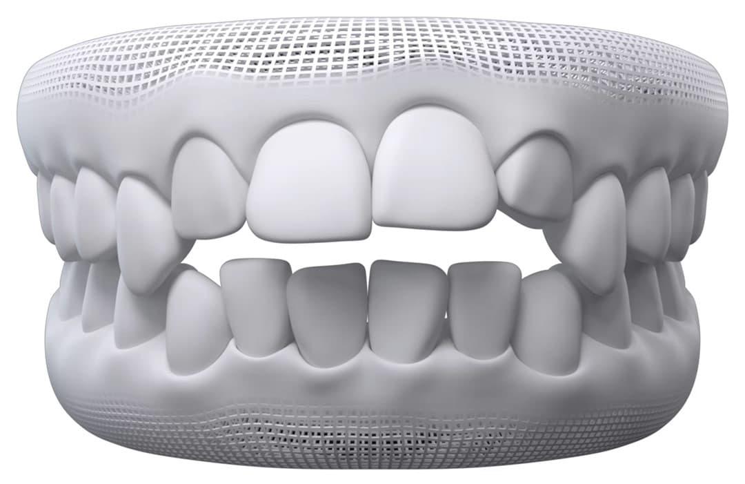 Invisalign for Open Bite: A Game-Changer in Orthodontic Treatment