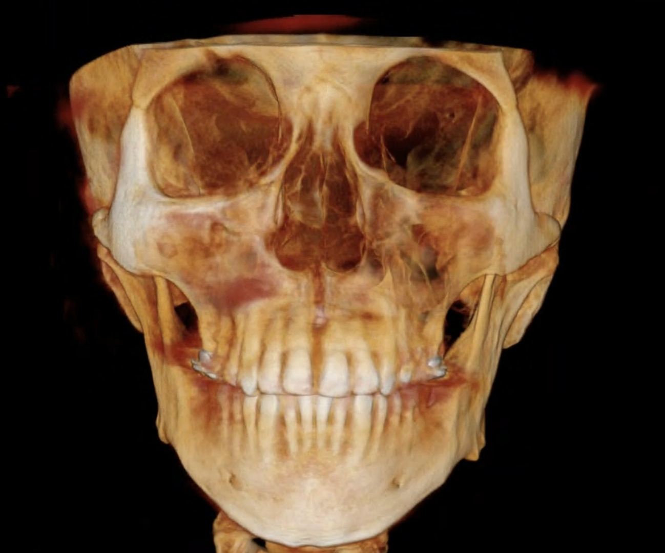 3D CBCT scan showing expanded maxilla and wider nasal cavity after MARPE