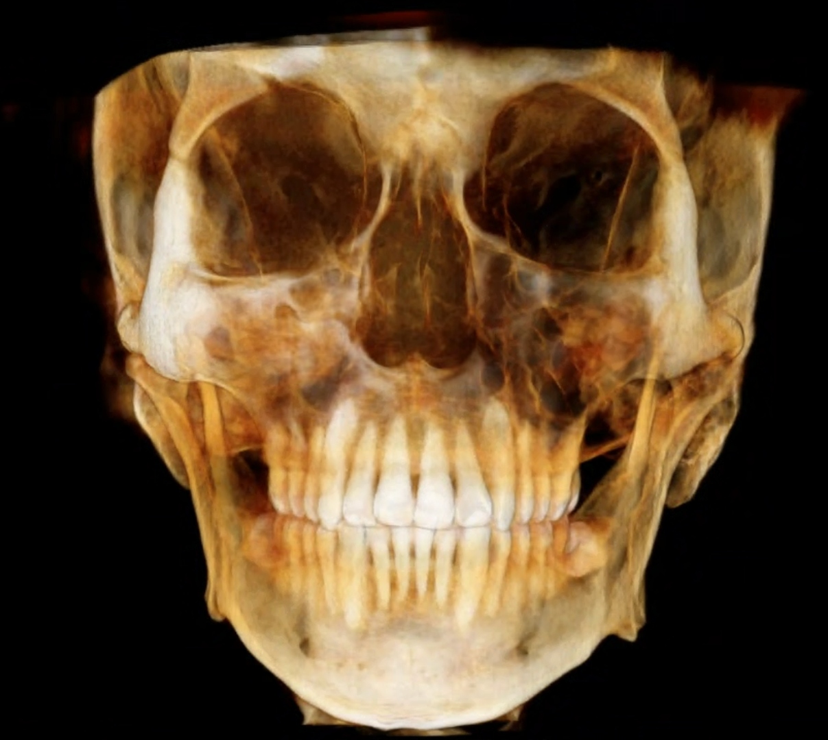 3D CBCT scan showing narrow maxilla before MARPE