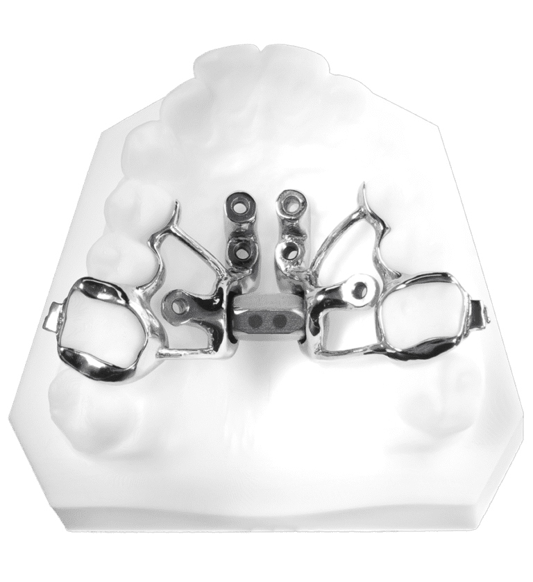 Custom MARPE palatal expander appliance on dental model